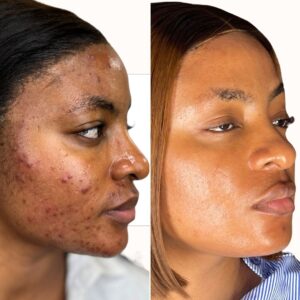 ACNE TREATMENT PROTOCOL (SINGLE) - #Essential Choice