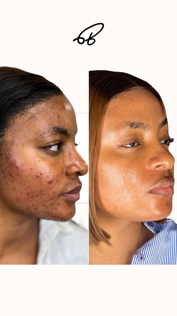 ACNE TREATMENT PROTOCOL (3 MONTHS) - #Popular Choice - Image 3