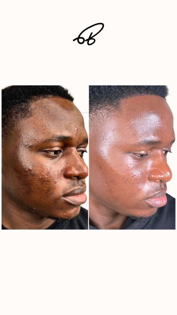 ACNE TREATMENT PROTOCOL (3 MONTHS) - #Popular Choice - Image 4
