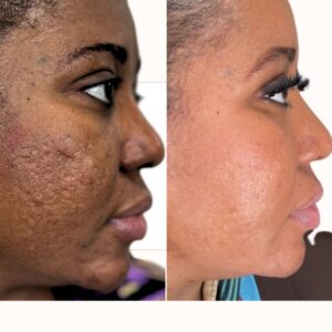 SCAR REVISION PROTOCOL [SRP] (3 MONTHS) #Best Choice