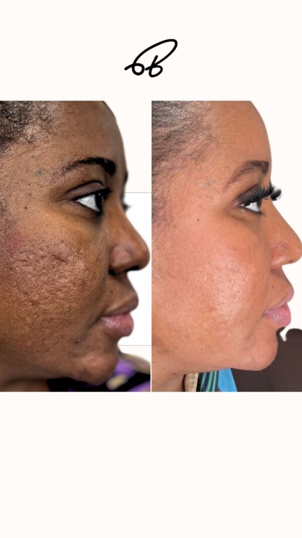 SCAR REVISION PROTOCOL [SRP] (3 MONTHS) #Best Choice