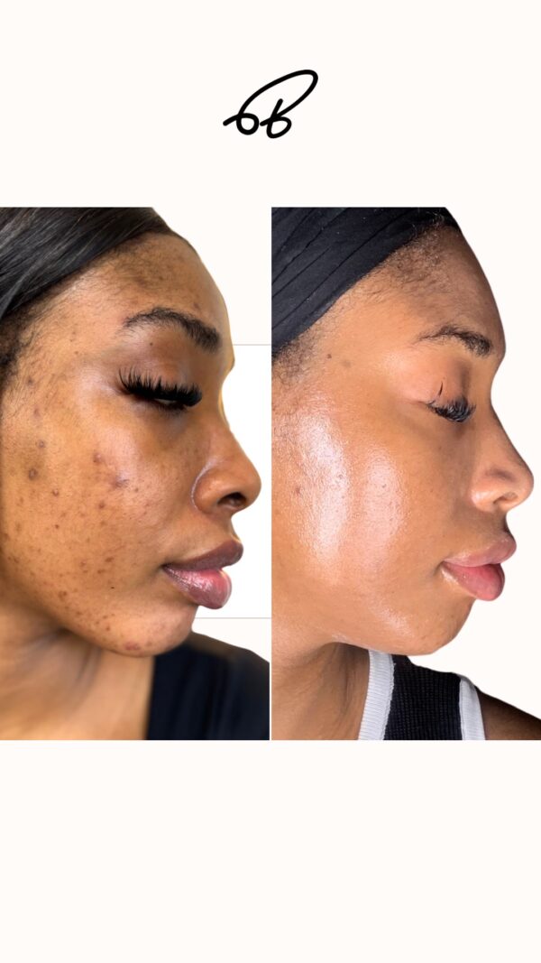 HYPERPIGMENTATION TREATMENT PROTOCOL (3 MONTHS) #Best Choice - Image 4
