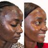 ACNE TREATMENT PROTOCOL (SINGLE) - #Essential Choice