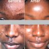 ACNE TREATMENT PROTOCOL (SINGLE) - #Essential Choice - Image 2