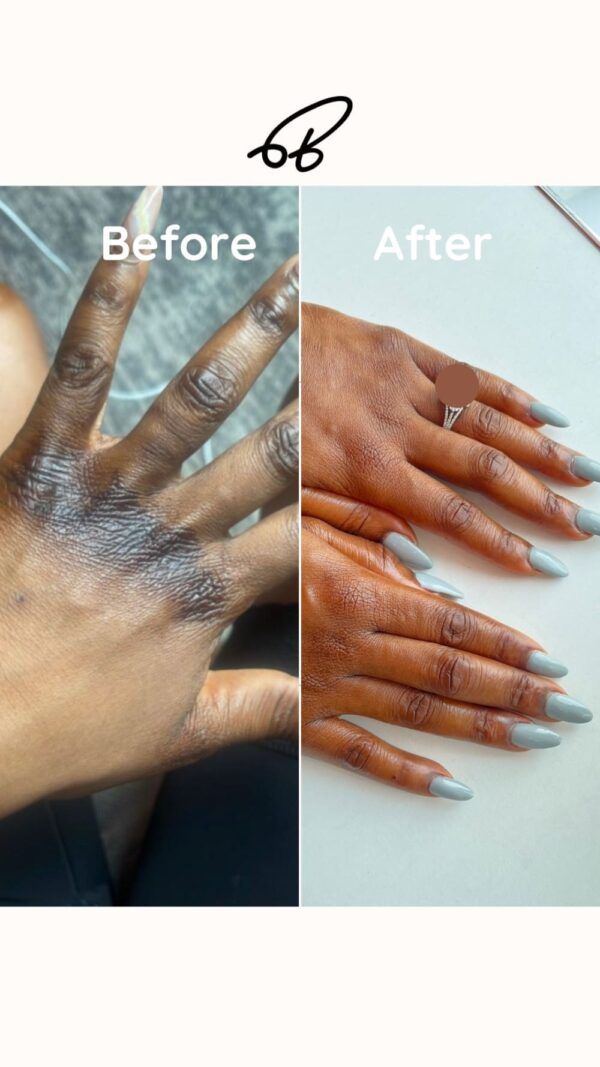HYPERPIGMENTATION TREATMENT PROTOCOL (3 MONTHS) #Best Choice - Image 6