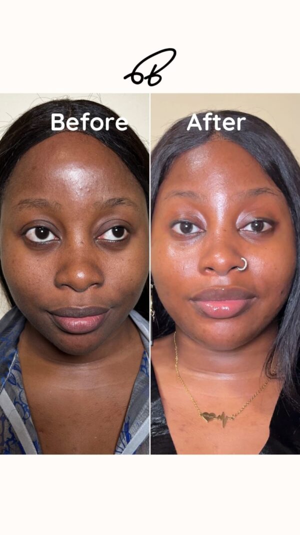 HYPERPIGMENTATION TREATMENT PROTOCOL (3 MONTHS) #Best Choice - Image 10