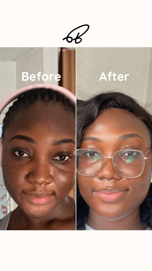 HYPERPIGMENTATION TREATMENT PROTOCOL (3 MONTHS) #Best Choice - Image 9