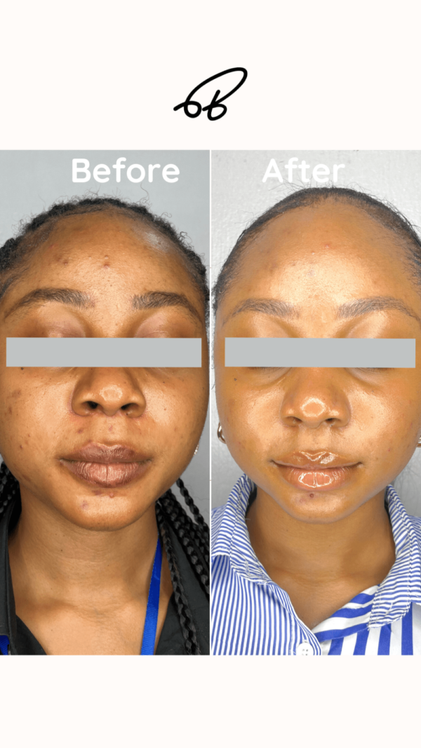 HYPERPIGMENTATION TREATMENT PROTOCOL (3 MONTHS) #Best Choice - Image 2