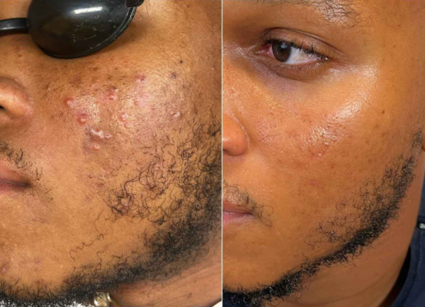 ACNE TREATMENT PROTOCOL (3 MONTHS) - #Popular Choice - Image 9