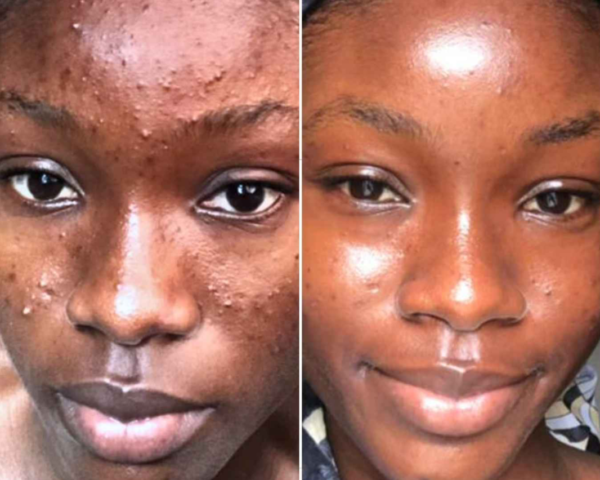 ACNE TREATMENT PROTOCOL (3 MONTHS) - #Popular Choice - Image 8