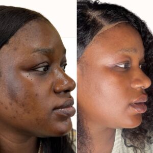 HYPERPIGMENTATION TREATMENT PROTOCOL (SINGLE)