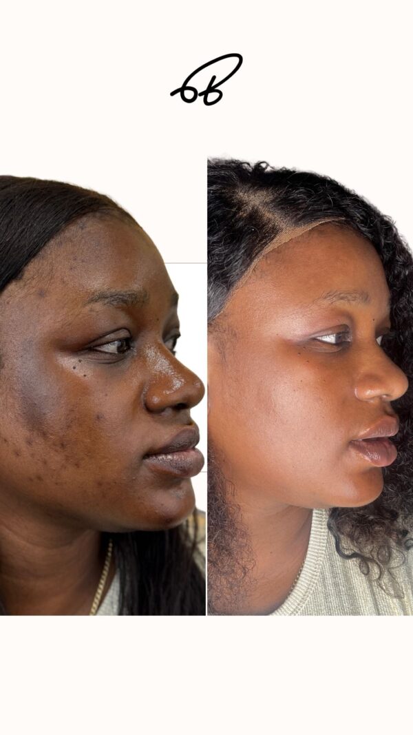 HYPERPIGMENTATION TREATMENT PROTOCOL (SINGLE)