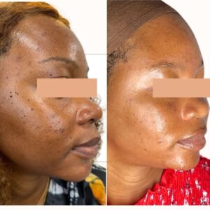 EPIDERMAL EXCISION FOR MOLES, SKIN TAGS & DPN