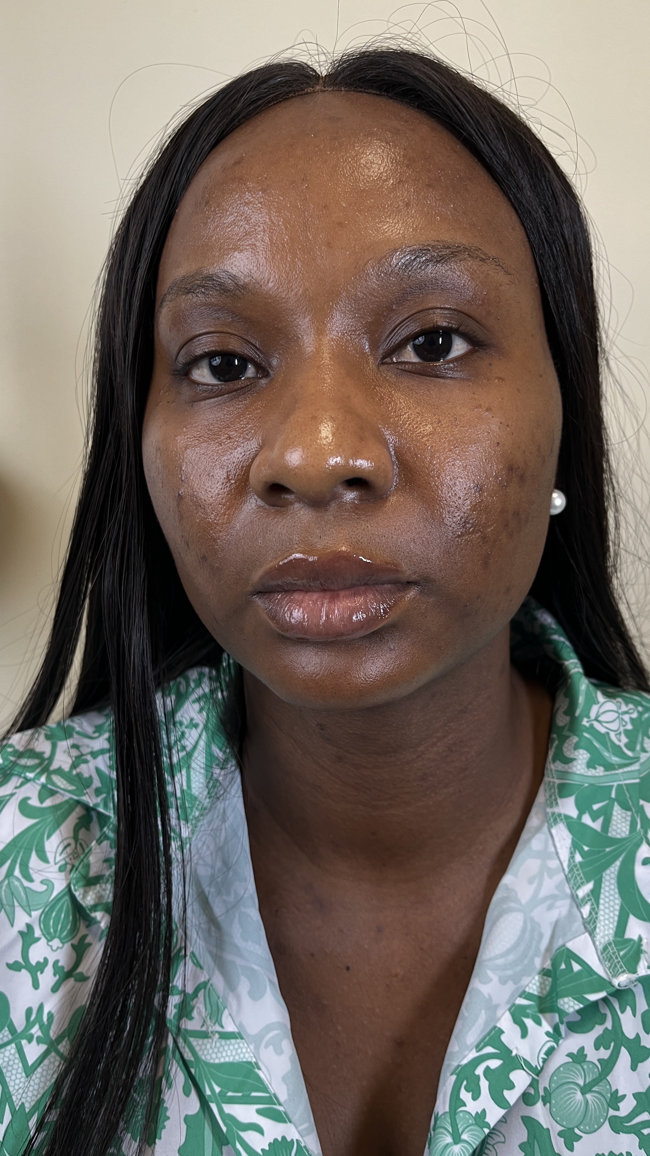 Client before photograph at Bregha Beauty Clinic, Lekki, Lagos
