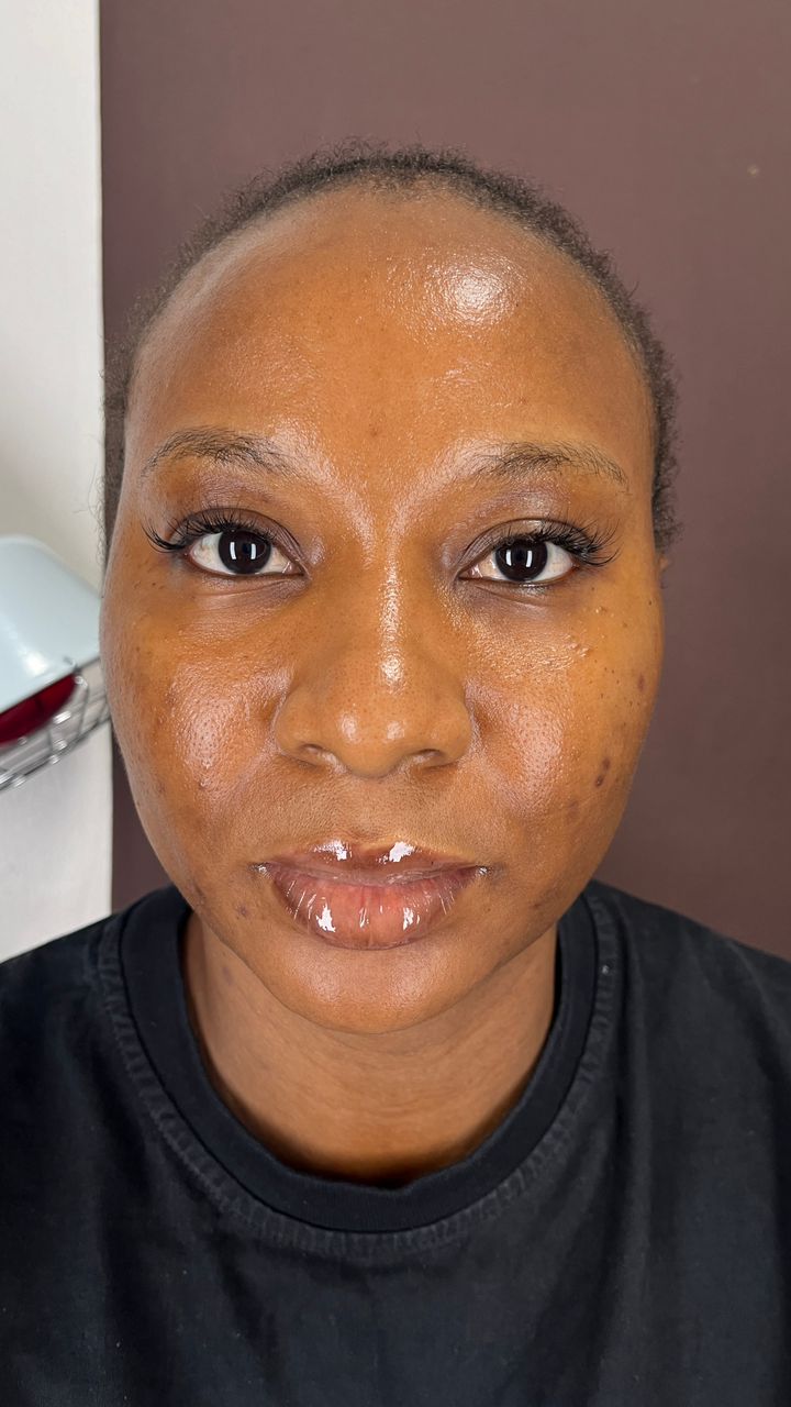Client progress photograph at Bregha Beauty Clinic, Lekki, Lagos